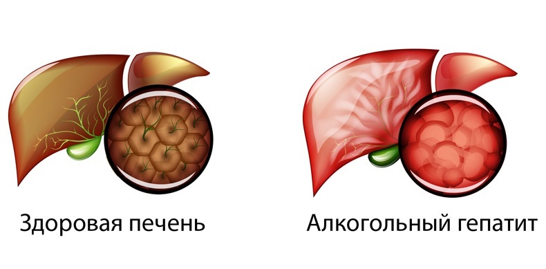 анализ крови лдг повышен